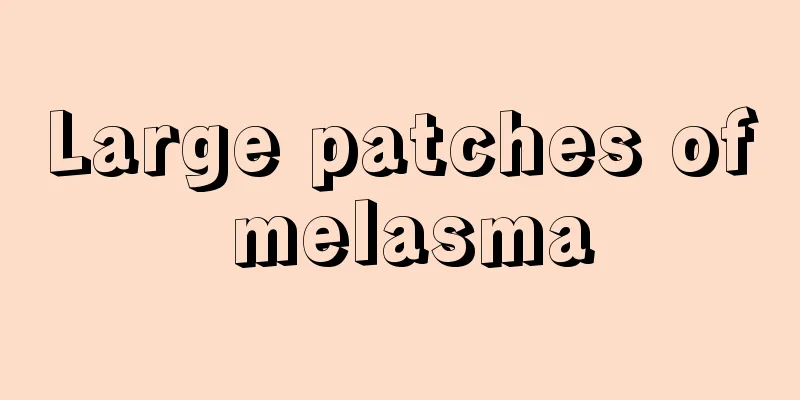 Large patches of melasma