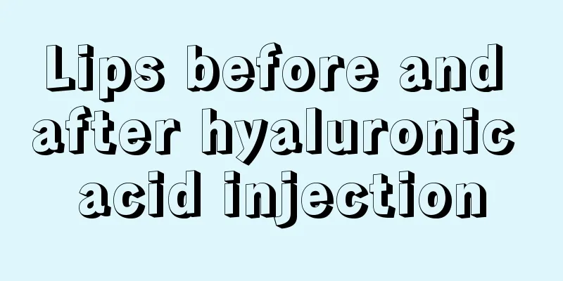 Lips before and after hyaluronic acid injection