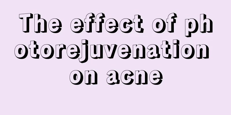 The effect of photorejuvenation on acne